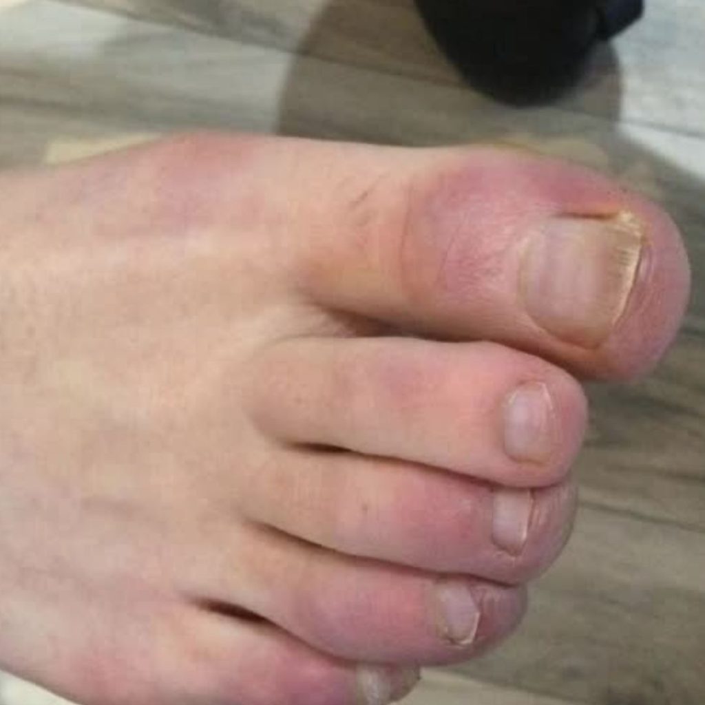 Fungal Nail - After Treatment