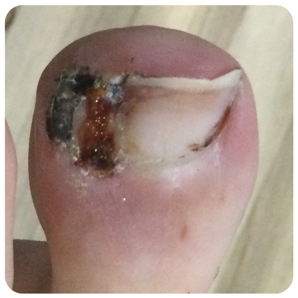 Ingrowing Toenail Surgery - Before Treatment