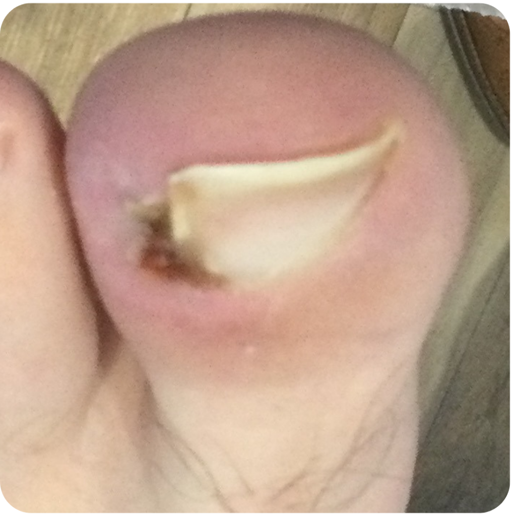 Ingrowing Toenail Surgery - During Treatment