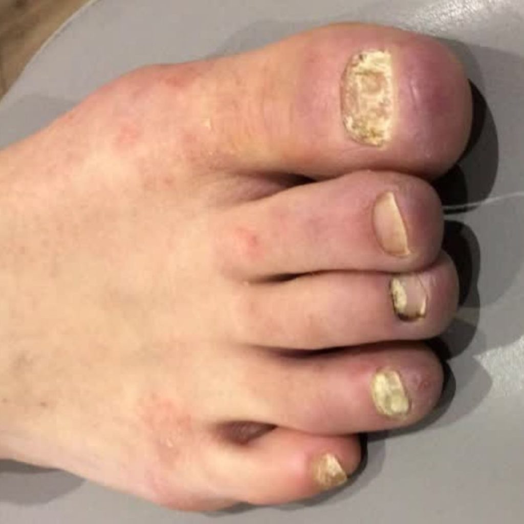 Fungal Nail - Before Treatment