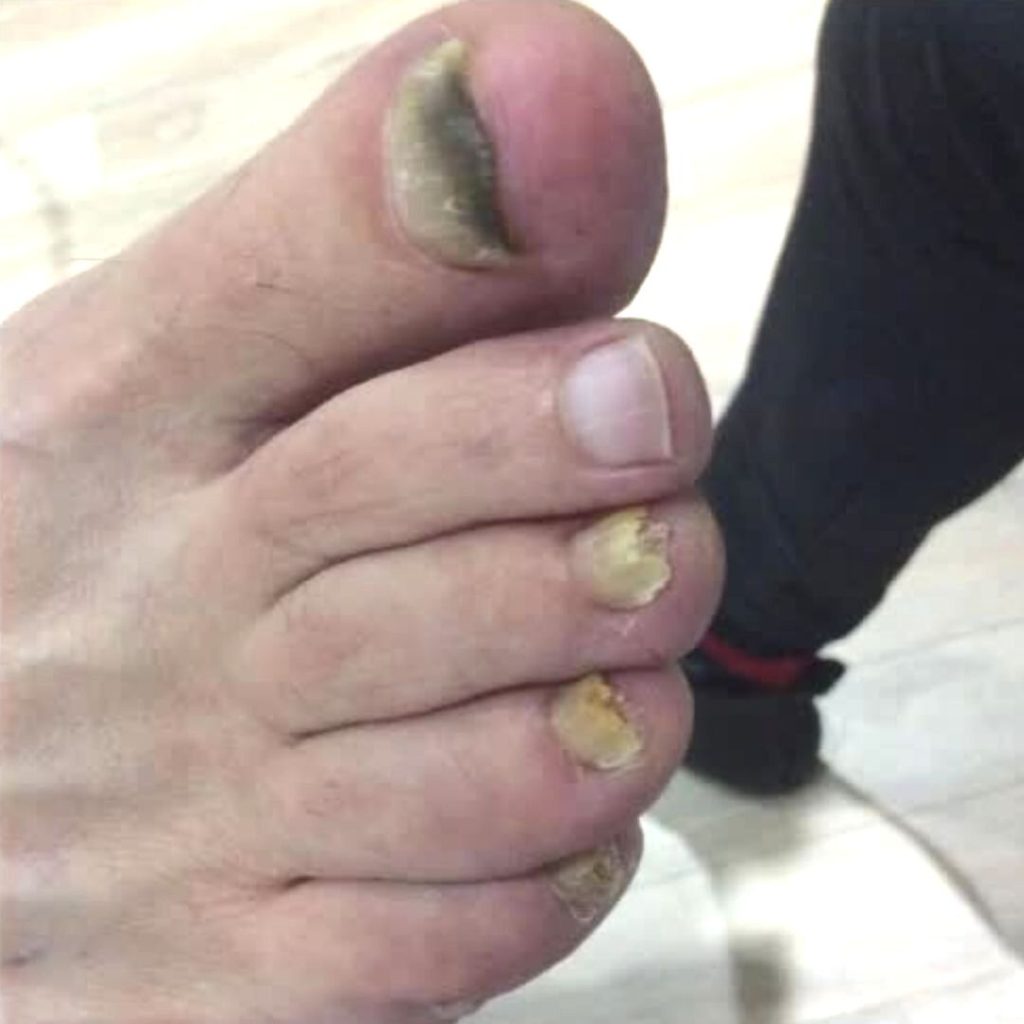 Fungal Nail - Before Treatment