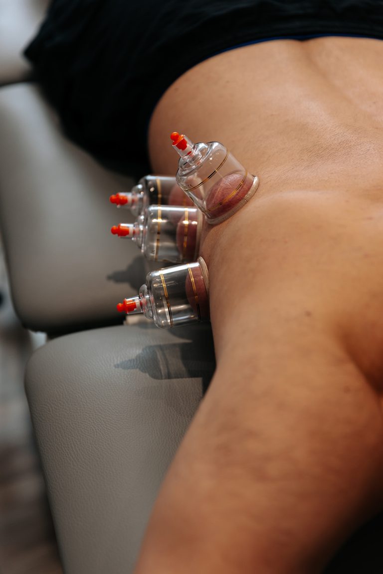 Cupping technique used my our Manual Therapists